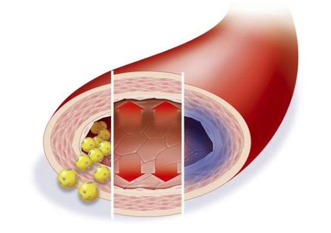 低密度膽固醇超標(biāo)，多久會影響血管健康？來看看鹽城康復(fù)醫(yī)院醫(yī)生怎么說